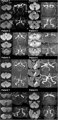Bilateral Vertebral Artery Hypoplasia and Fetal-Type Variants of the Posterior Cerebral Artery in Acute Ischemic Stroke
